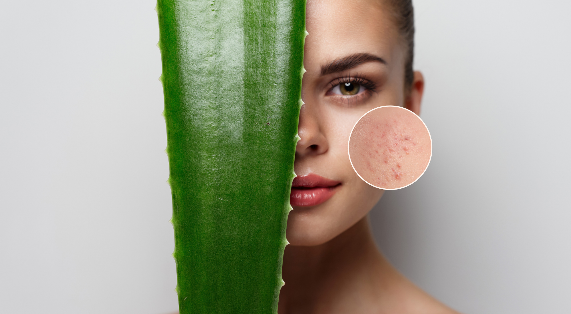 Say Goodbye to acne with the natural power of Aloe vera