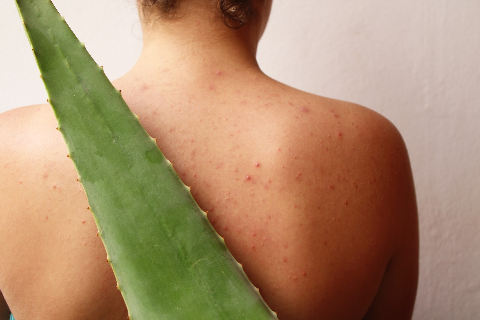 Aloe vera für Akne