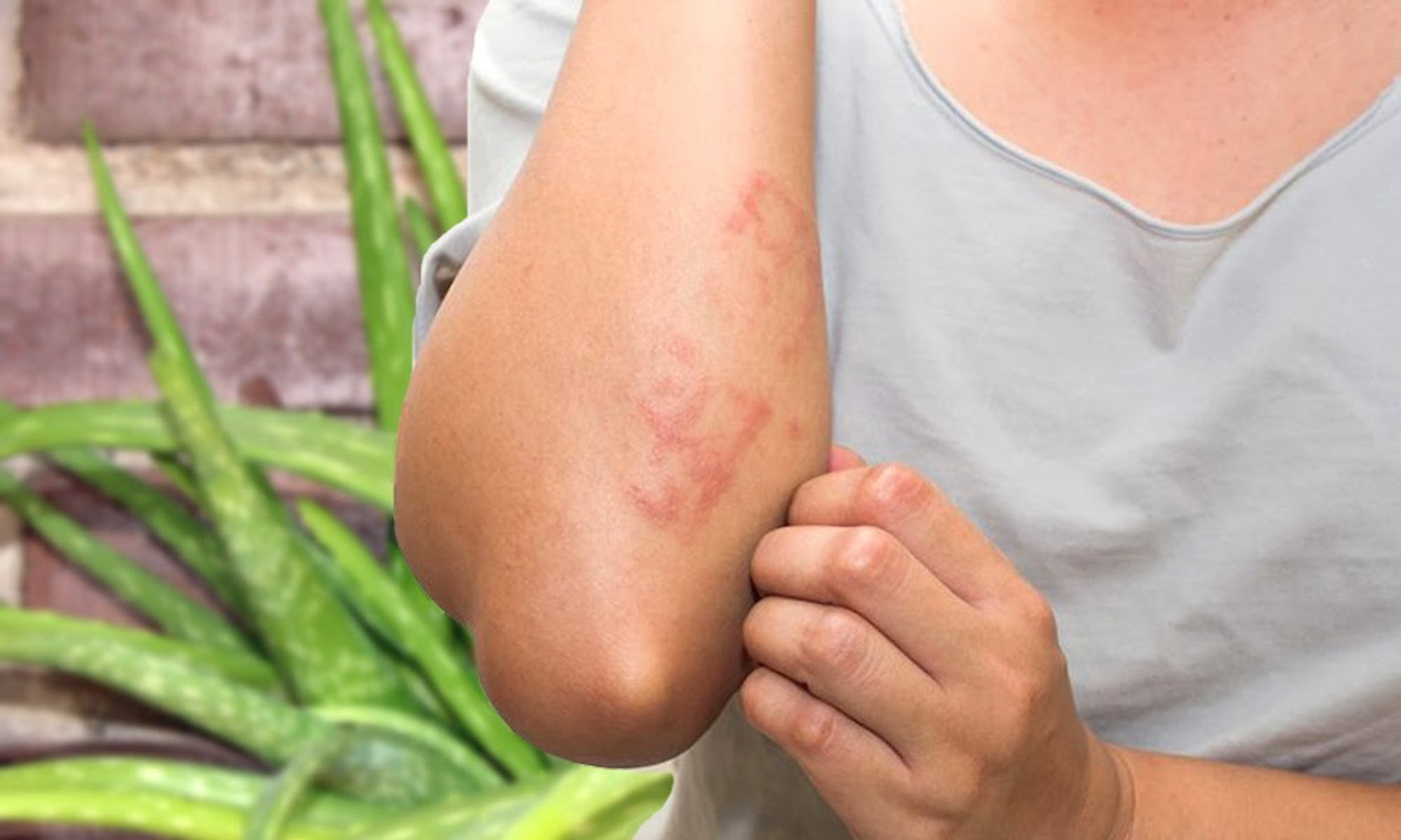 Eczema and Psoriasis, natural treatment